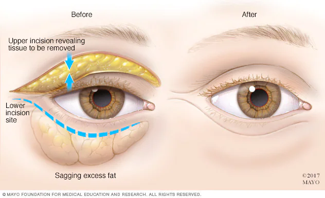 Blepharoplasty: Eyes Surgery