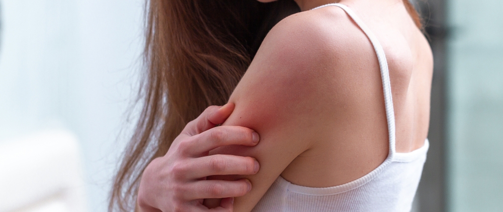 eczema rash on skin