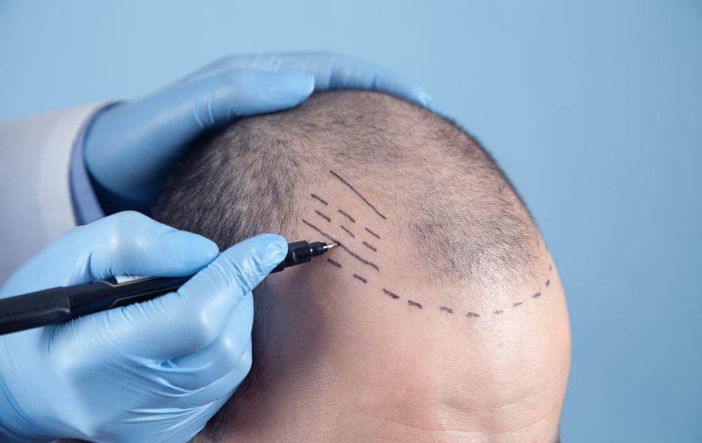 Hair Transplant Cost: Top 5 Countries