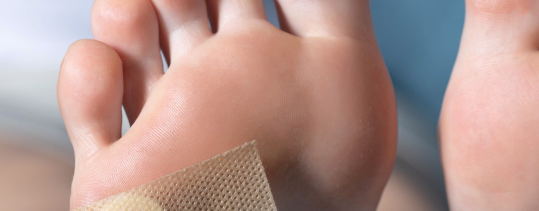 foot callus covered with a derma patch