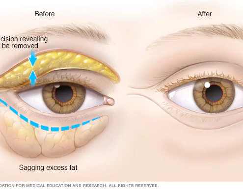 Blepharoplasty: Eyes Surgery
