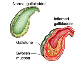 Inflamed gallbladder