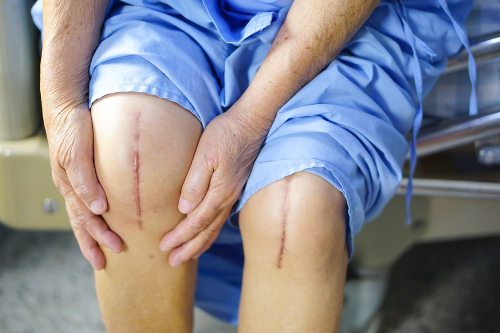 scars on knee post recovery from knee transplant surgery
