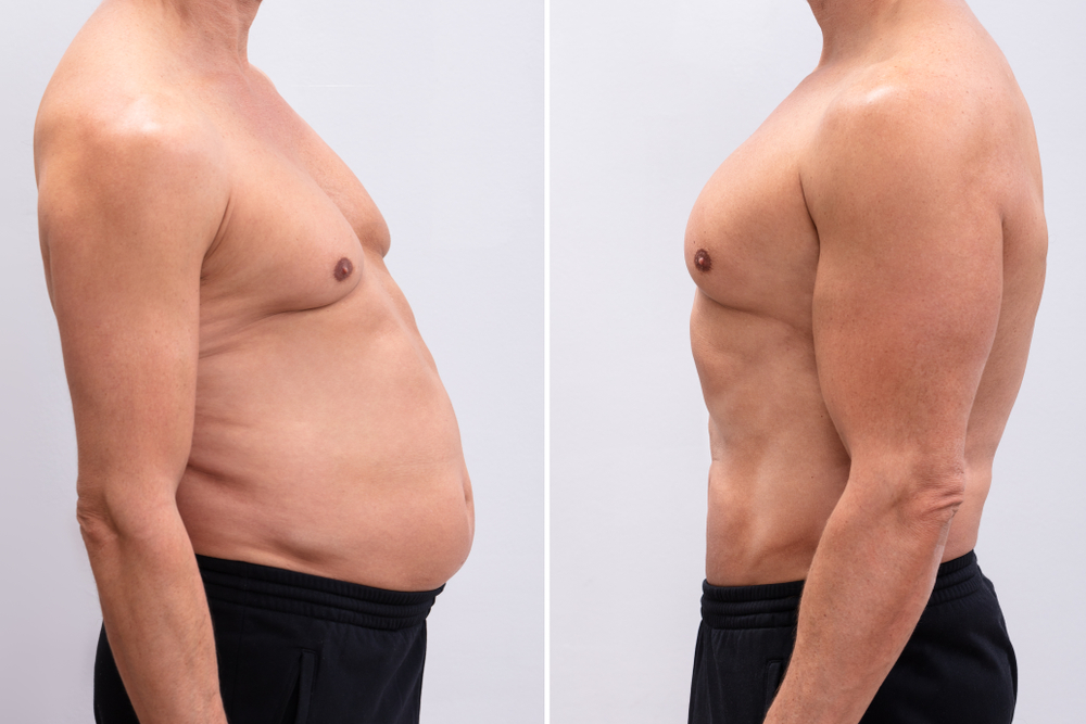 Before and after of a successful tummy tuck
