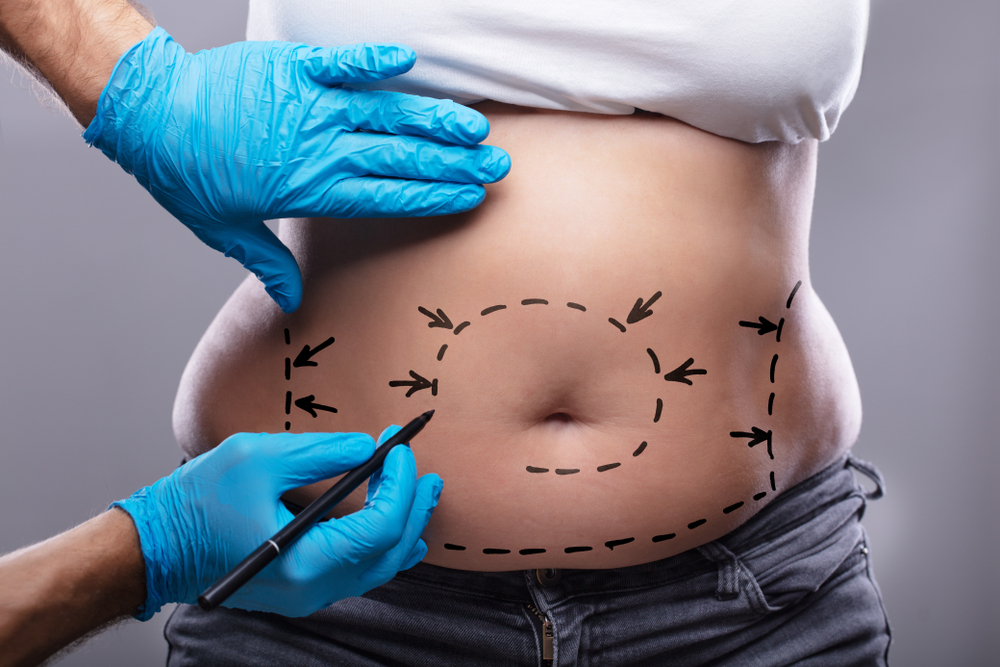 Marking on the stomach for a tummy tuck surgery