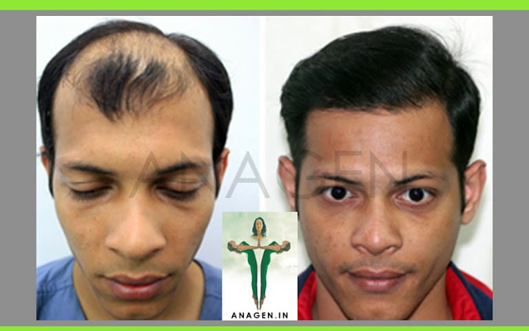 Anagen Hair Transplant Clinic, Mumbai, Maharashtra - Travocure