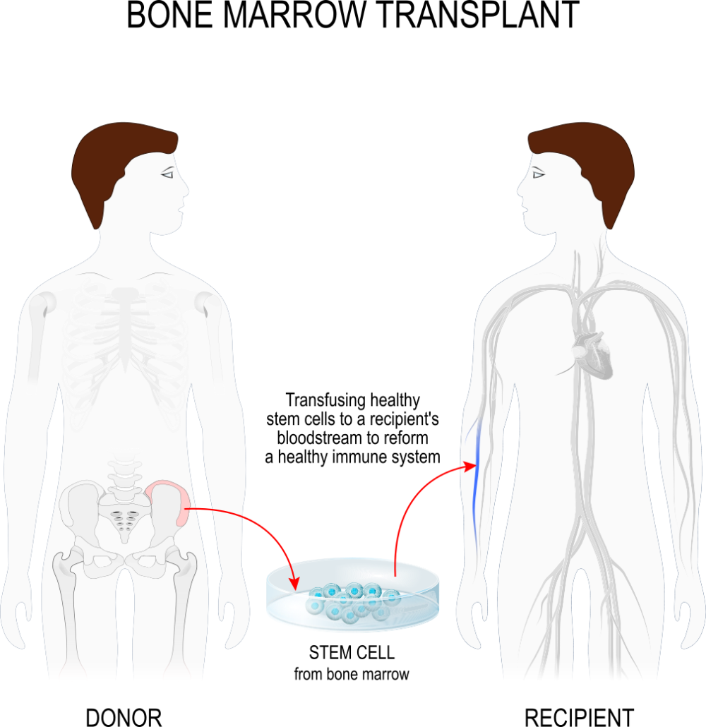 Diagram of bone marrow transplant