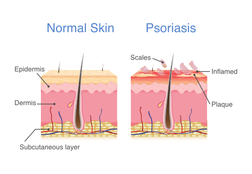 difference between normal skin and psoriasis