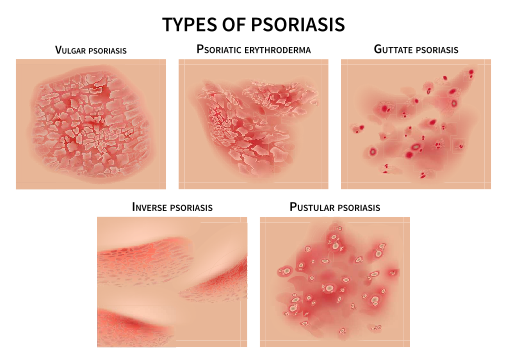 The different types of psoriasis