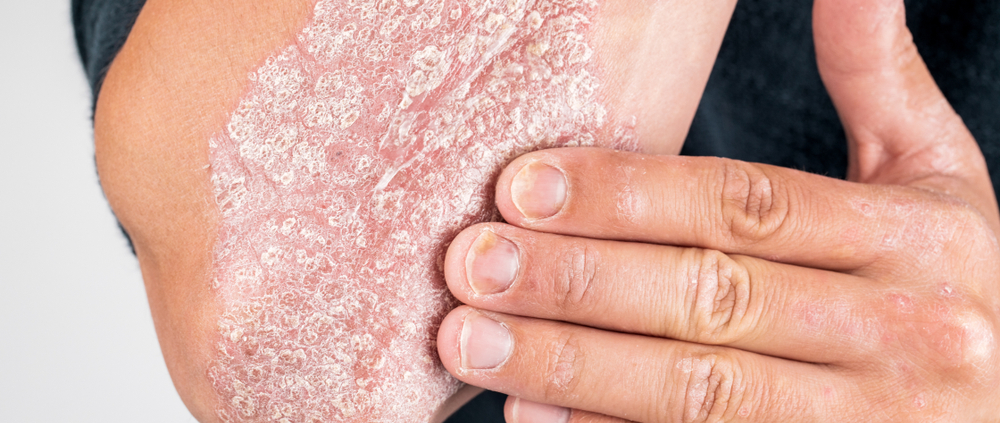 psoriasis