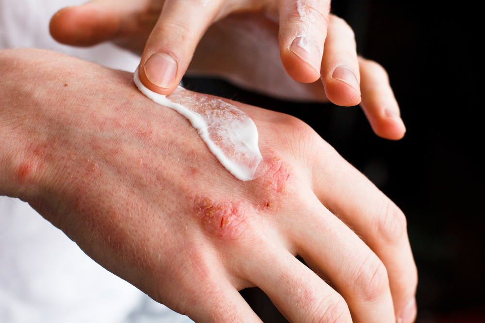 applying ointment on an eczema rash