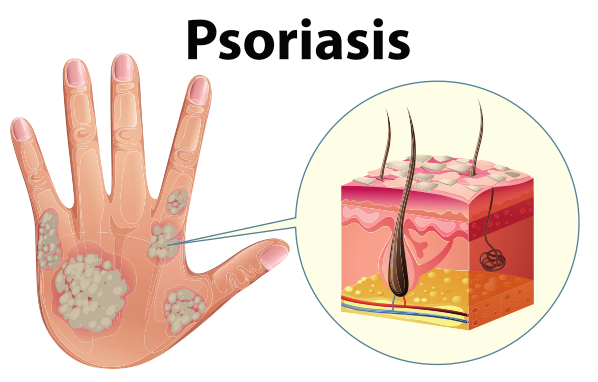 psoriasis