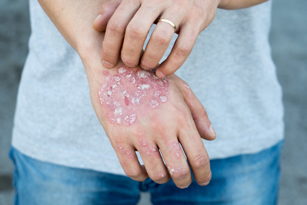 psoriasis on the hand, back of the hand