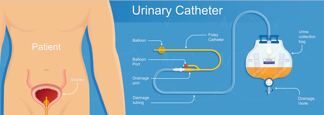 bladder cancer treatment with a urinary catheter