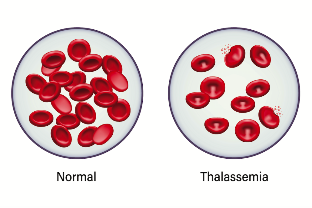 normal vs thalassemia blood platelets