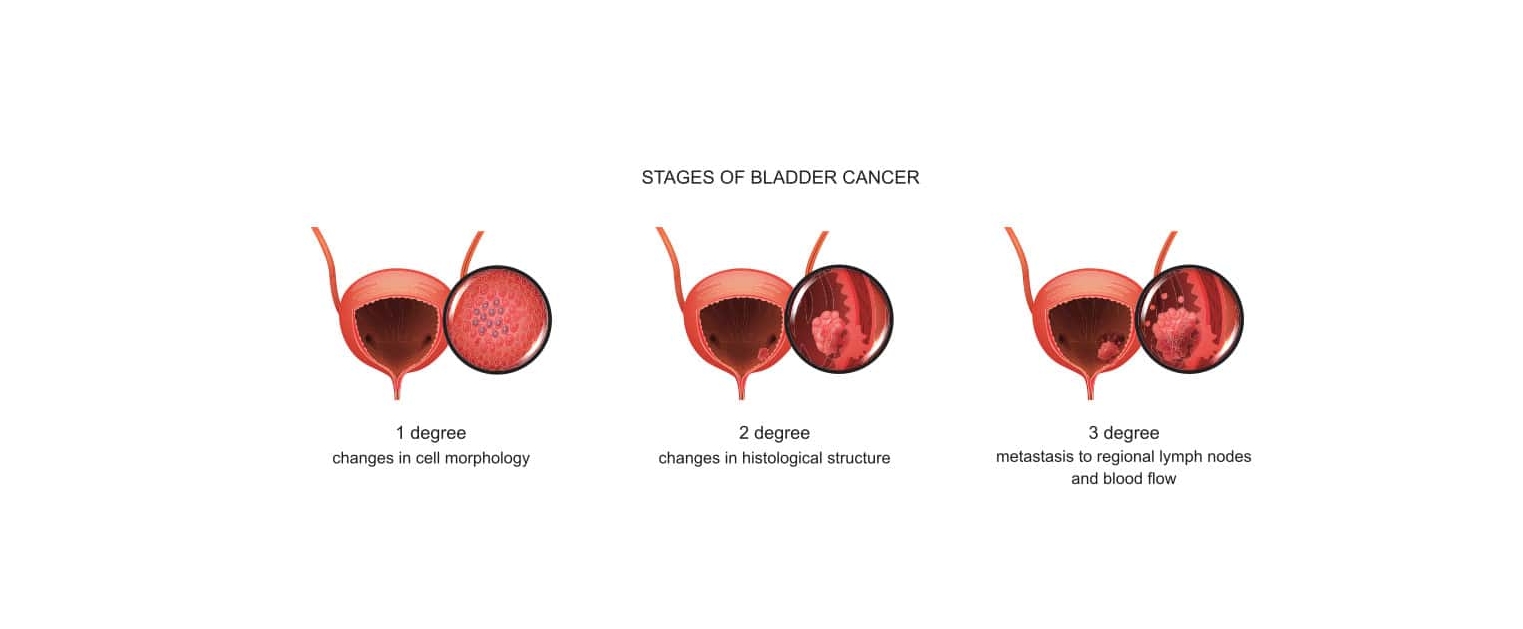 Stages of bladder cancer