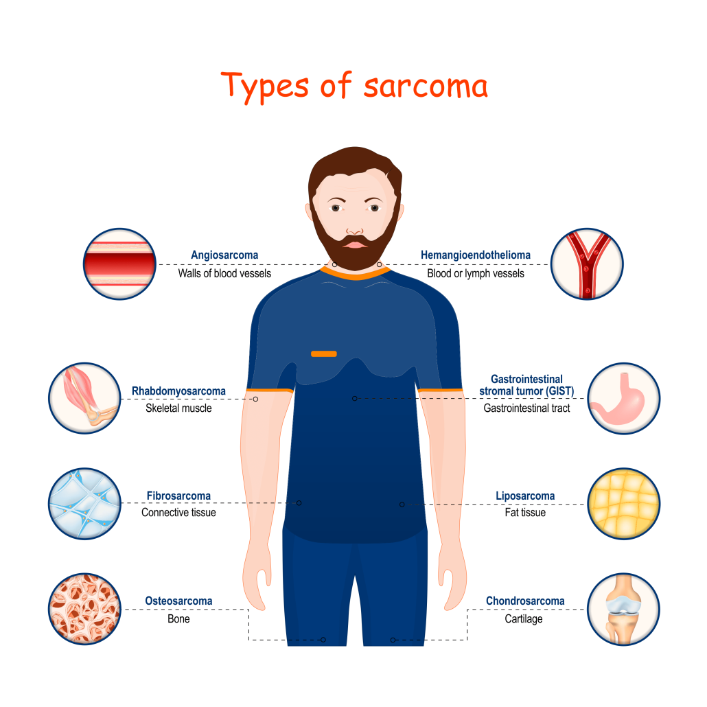 types of sarcoma