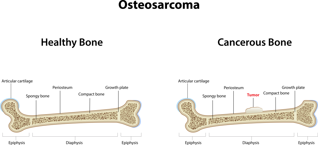 difference between healthy and cancerous bone for osteosarcoma