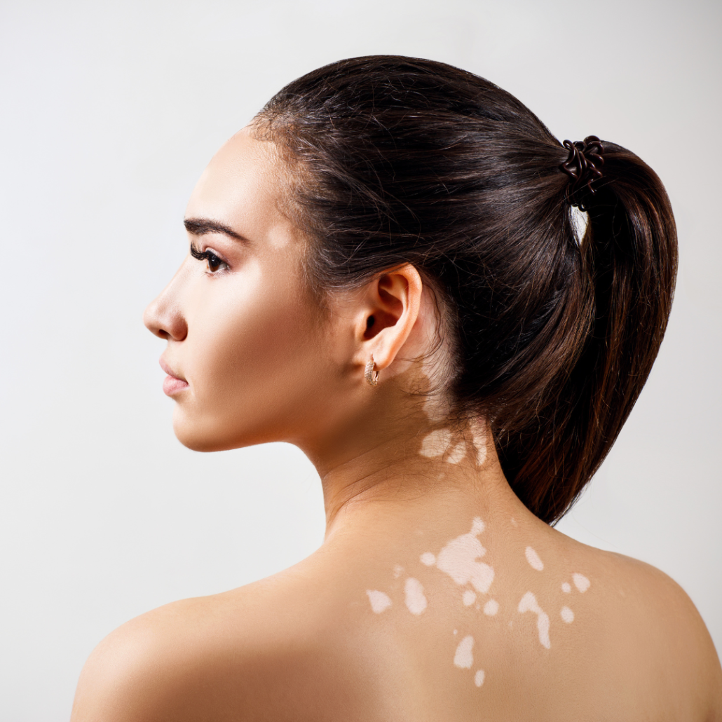 woman with vitiligo on her back