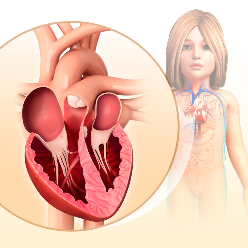 Human heart atrias - atrioventricular canal defect